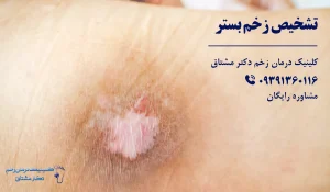 تشخیص زخم بستر