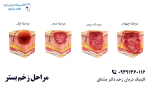 مراحل زخم بستر