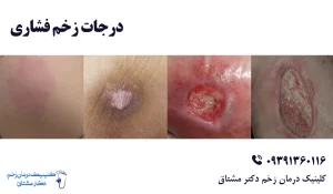 درمان زخم بستر