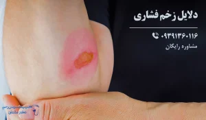 دلایل زخم بستر