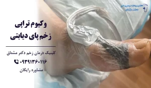 درمان زخم پای دیابتی وکیوم تراپی