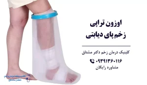 درمان زخم پای دیابتی اوزون تراپی
