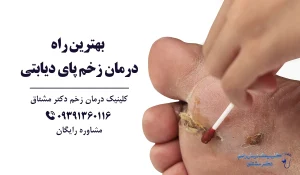 بهترین روش درمان زخم پای دیابتی