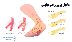 دلیل زخم پای دیابتی