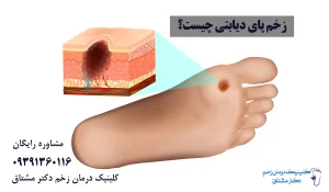 زخم پای دیابتی چیست