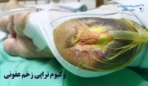وکیوم تراپی زخم عفونی