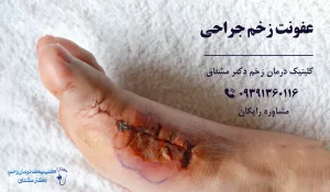 عفونت زخم جراحی