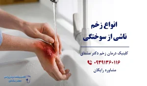 درمان زخم حاد سوختگی