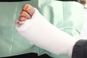 آفلودینگ زخم پای دیابتی