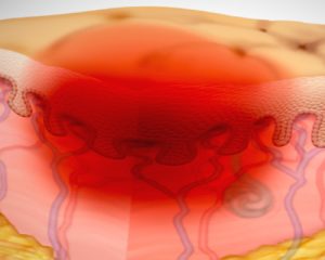 زخم بستر چیست، علل و راه های درمان