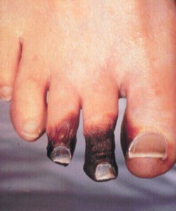 پیشگیری از گانگرن پای دیابتی