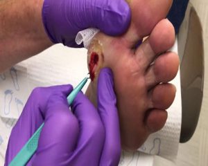 مدیریت زخم پای دیابتی با دبریدمان