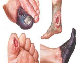 عوارض درمان نکردن زخم پای دیابتی