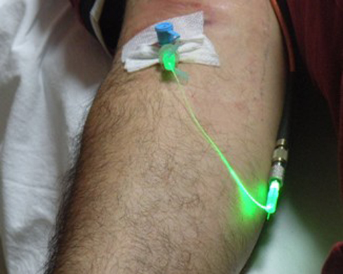 درمان زخم پای دیابتی با لیزر کم توان