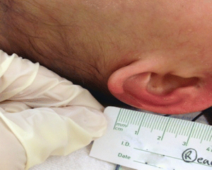 زخم بستر در کودکان