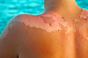 مراقبت از زخم های سوختگی تابستانی
