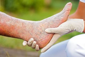 چه عواملی باعث شده است که پای من آلوده شود و چگونه آن را درمان کنم؟