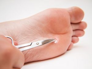 زخم پای دیابتی می تواند کشنده باشد - این درمان جدید می تواند به شما کمک کند.