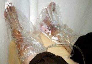 اوزون تراپی زخم پای دیابتی