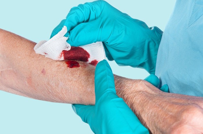 6 درمان خانگی برای متوقف کردن خونریزی