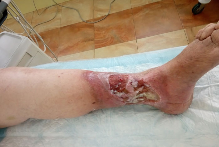 درمان زخم پای دیابتی و زخم تروفیک