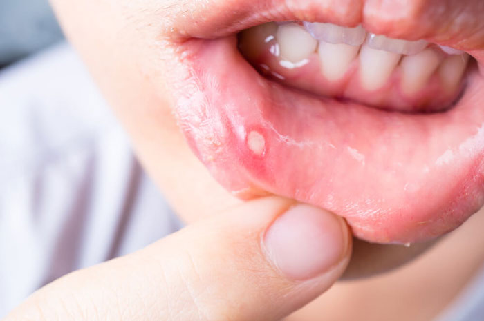 انواع زخم دهان و روش های درمان خانگی آنها