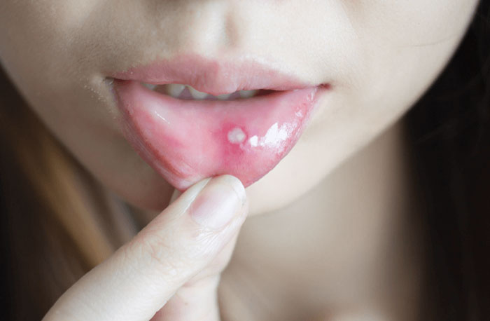 انواع زخم دهان و روش های درمان خانگی آنها