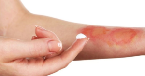 درمان انواع سوختگی